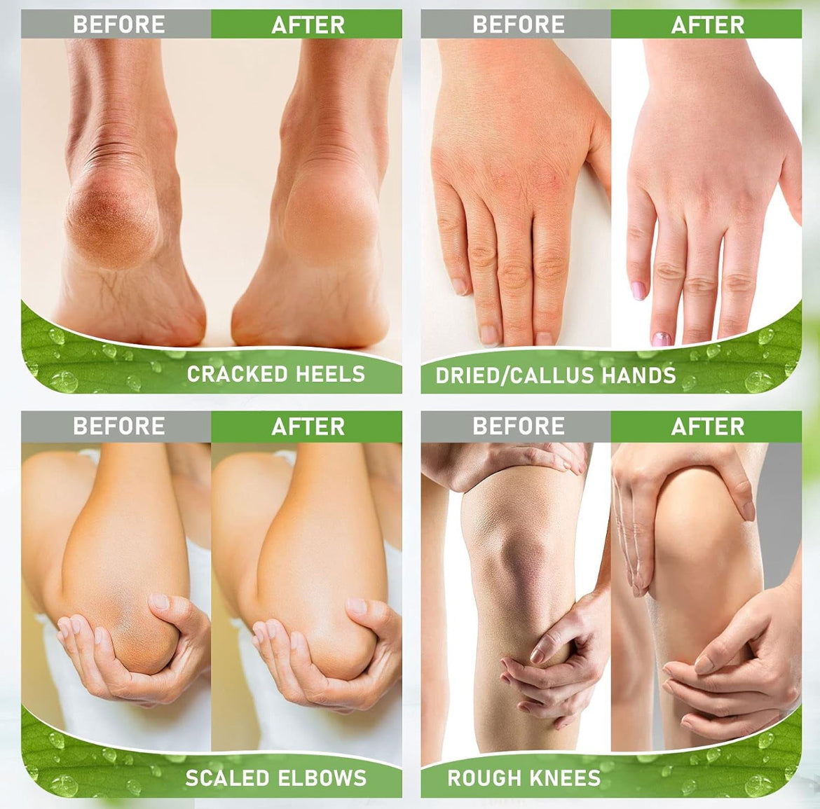 Smooth Feet Deal – Buy a Callus Remover, Get a FREE 42% Urea Cream!